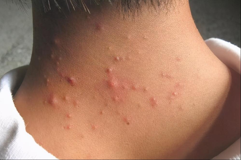 *疮痤**长在背上怎么办？如何治疗呢？