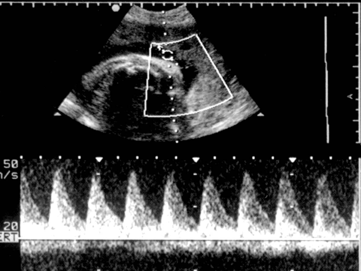 脐带超声表现,超声如何判断脐带绕颈几周