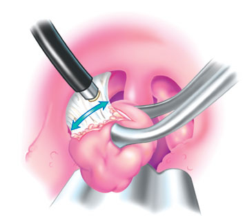 扁桃体切除会影响以后的免疫力吗,扁桃体切除后对免疫力有影响吗