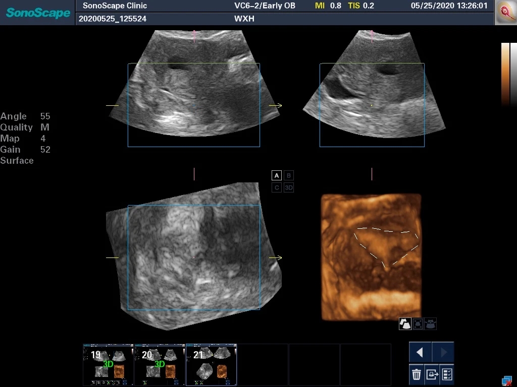 轻微宫腔粘连手术成功案例,轻度宫腔粘连分离术是大手术吗