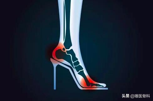 足底筋膜炎跑步脚后跟疼怎么办,走路脚跟痛当心足底筋膜炎