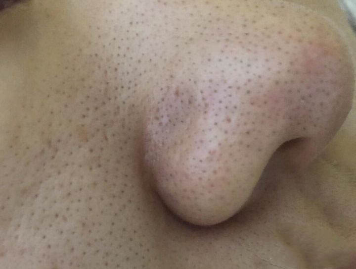 黑头怎么去除最有效最快,黑头怎么去除最有效小孩