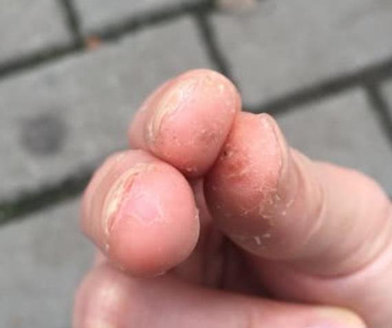 孩子春季手指脱皮是缺什么,手指脱皮是身体求救信号