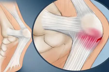 骨破坏怎么治疗最好,类风湿引起的骨侵蚀还能修复吗