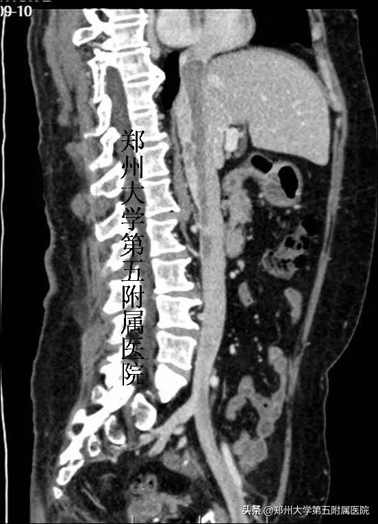 生死一脉牵，一例下腔静脉平滑肌瘤病的诊治历程