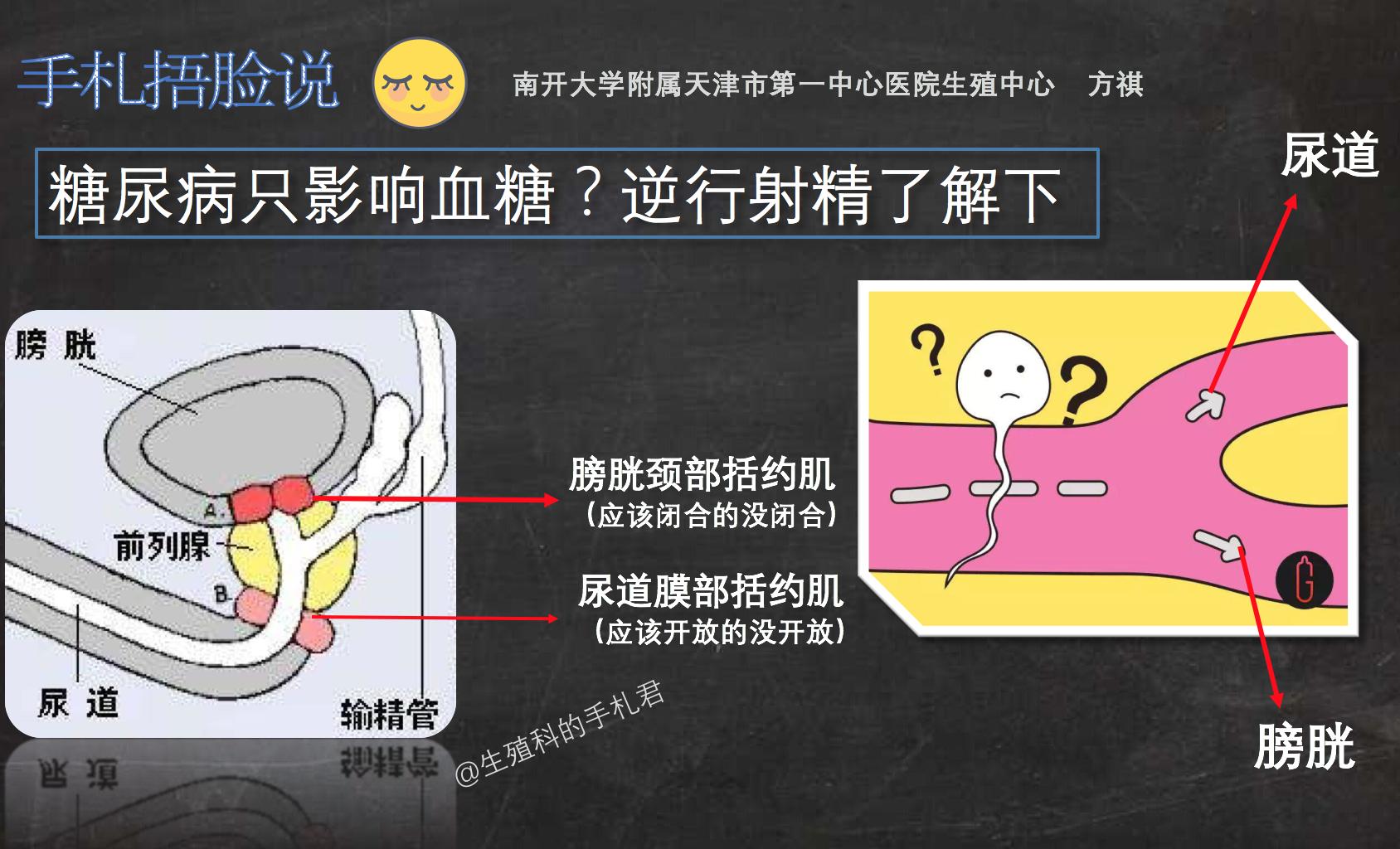 「辟谣」糖尿病只影响血糖？逆行射精这个锅它甩不掉