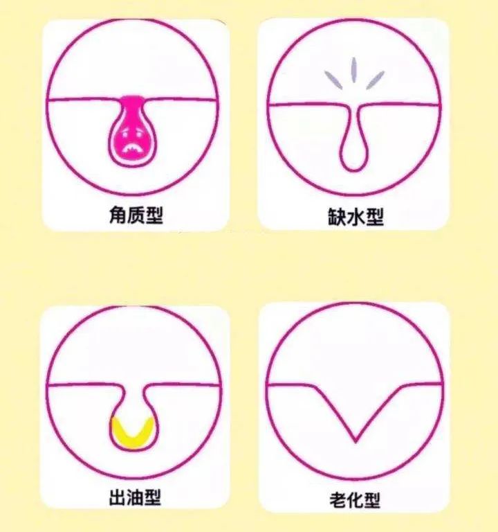 鼻头毛孔粗大如何改善缩小毛孔,皮肤毛孔粗大出汗可以缩小毛孔吗