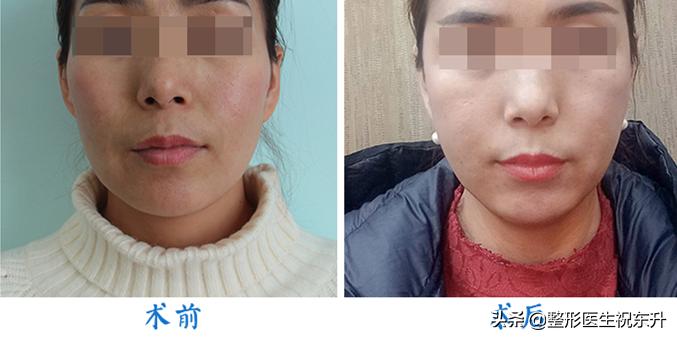 怎样可以去除法令纹和皱纹,如何消除法令纹提升脸部轮廓