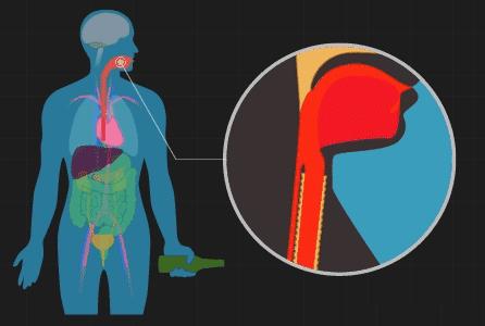 爱喝热水会得食道癌么,喝多少度热水容易导致癌症