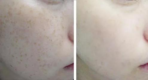 祛脸上斑点色斑的小妙招,一个动作教你如何淡化色斑