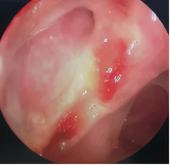 头痛眼睛胀痛流鼻涕全身无力,鼻子痛引起头痛眼睛疼是什么原因