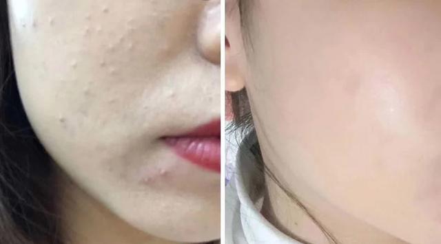 闭口挤了一直长怎么办,闭口到底要不要挤出来