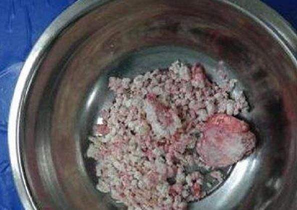 为什么医生不建议痛风石手术,医生为什么不建议痛风石手术