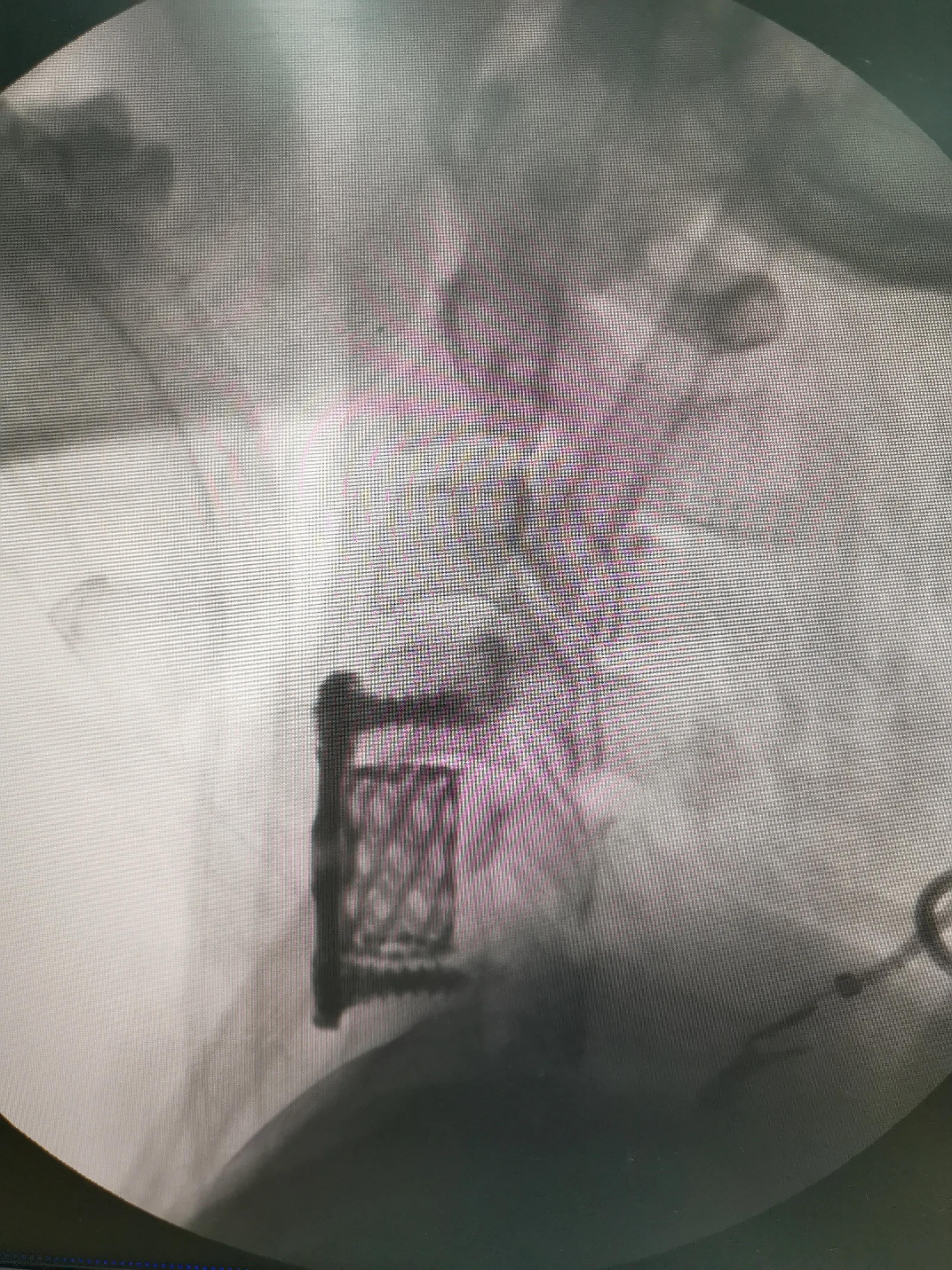 颈椎椎间盘轻度切除,颈椎全切除