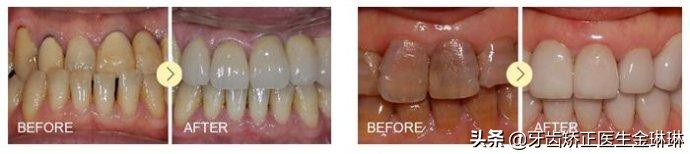 氟斑牙是什么样的图片,怎样区分氟斑牙和脱矿斑牙