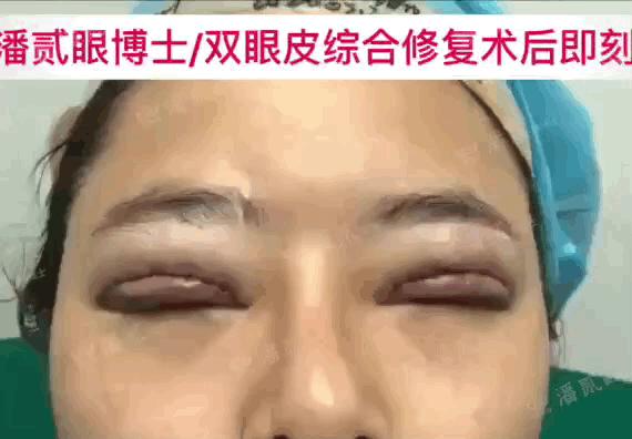 高难度修复双眼皮宽改窄恢复期,高难度双眼皮修复案例