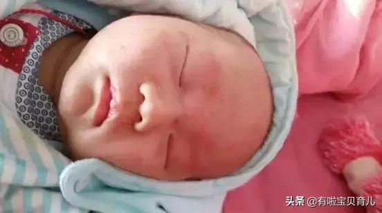 多图！热疹、湿疹、*麻疹荨**、幼儿急疹、水痘…区别和护理