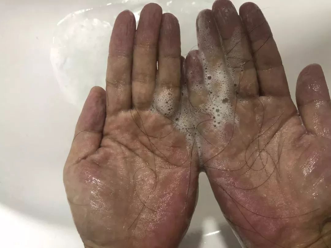 “十男八秃”的日本男人疯抢这瓶小黑钻!让头发不再掉了