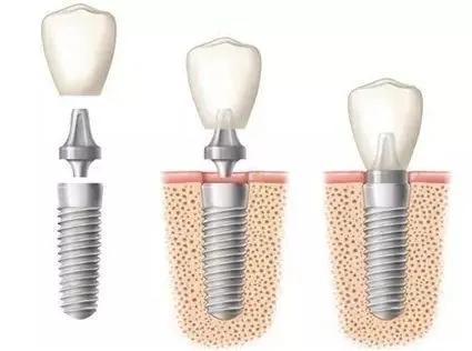 雅悦齿科烤瓷牙视频,明星都做了全烤瓷牙吗