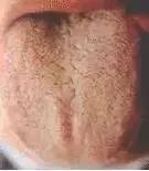 老中医舌苔从厚变薄了,任博士老中医讲舌苔