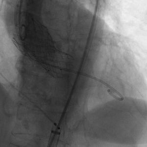 对造影剂过敏如何进行介入治疗,造影剂过敏迟发性治疗