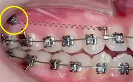 戴全牙套,初学者戴牙套的感受