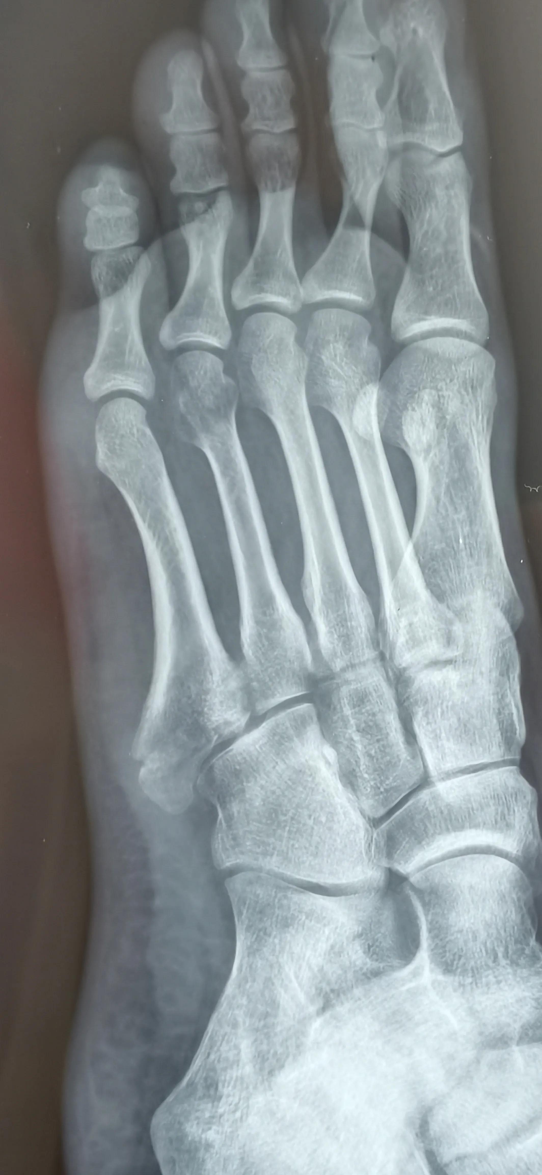 第五跖骨基底部骨折60天能走路吗,第五跖骨基底部骨折60天能脱拐吗