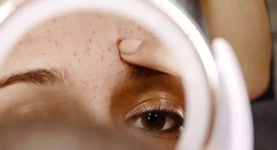 女生闭口痘痘怎么处理好得快,女生脸上有闭口痘痘怎么解决