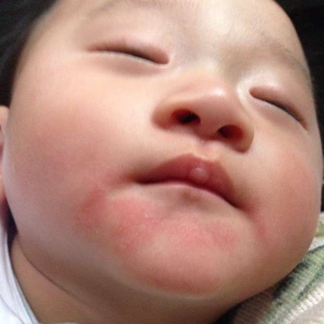 宝宝湿疹老反复教你6招轻松搞定,想要预防湿疹这五件事一定要做到