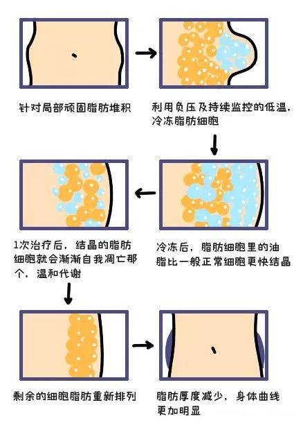 酷塑冷冻溶脂副作用是什么样的,酷塑冷冻溶脂的真实经历对比