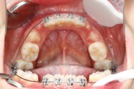 8岁的孩子能做牙齿矫正吗,7岁孩子矫正牙齿早吗