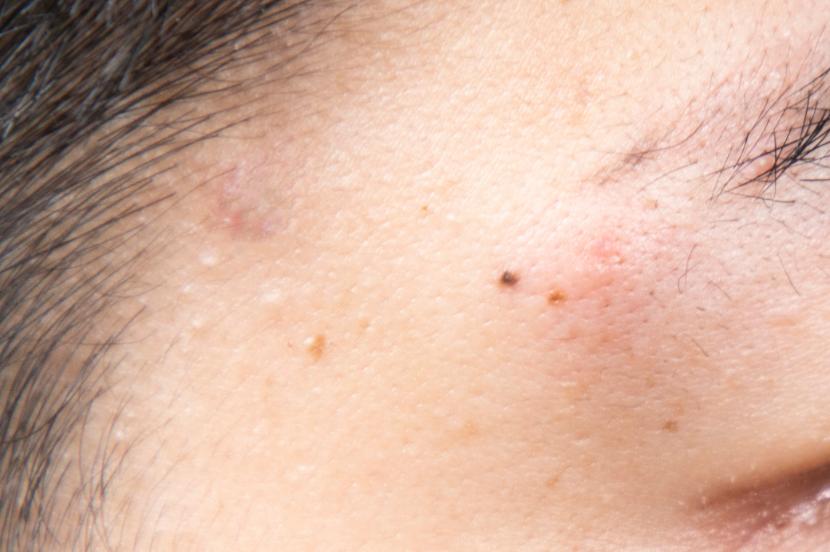 让无数姑娘无从下手的痘印，皮肤科医生有了解决新招