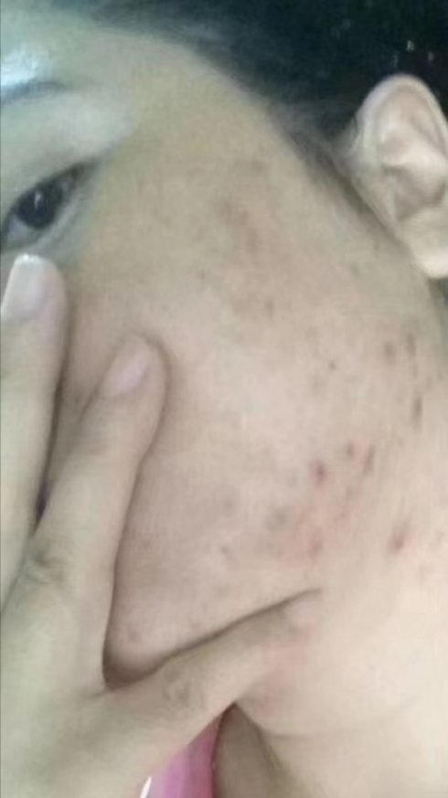 祛痘排行榜第一名痘印产品,祛痘印痘坑痘痕闭口最好方法