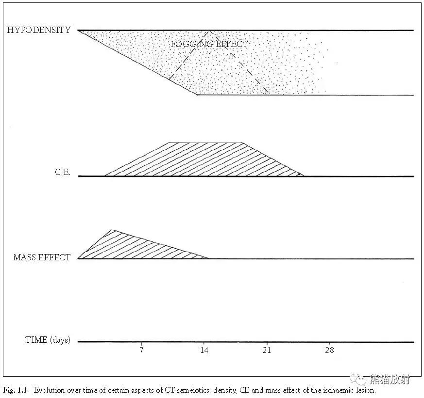 脑梗死丨演变、血供区域分布、CT表现