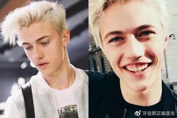 宝宝笑起来露牙龈是什么原因,牙齿矫正露牙龈笑怎么办