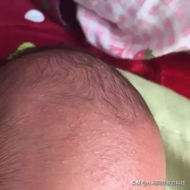 婴儿多久才会不怕热不会长痱子,小孩身上长痱子怎么消除