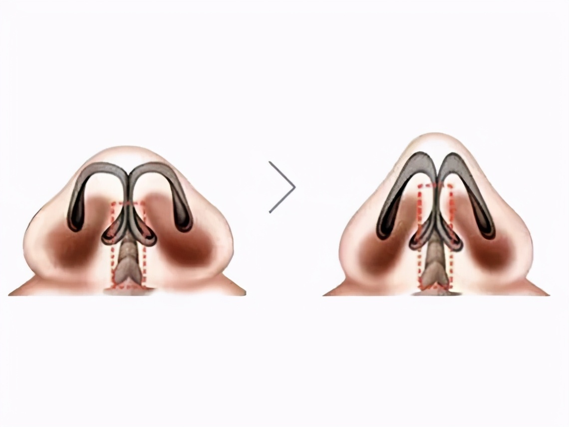 先天鼻小柱内凹的原因,鼻小柱往里凹怎么办