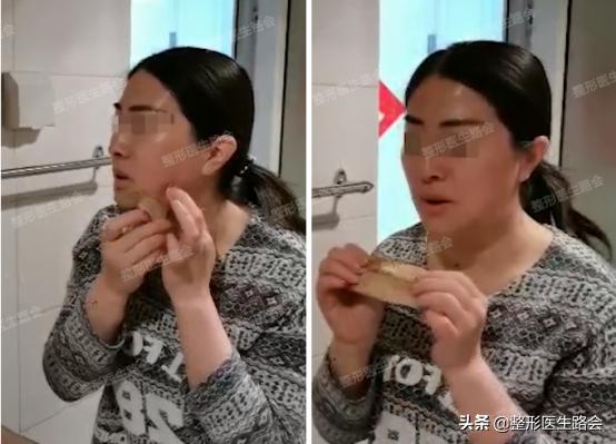 垫下巴手术流程,垫下巴手术的全过程