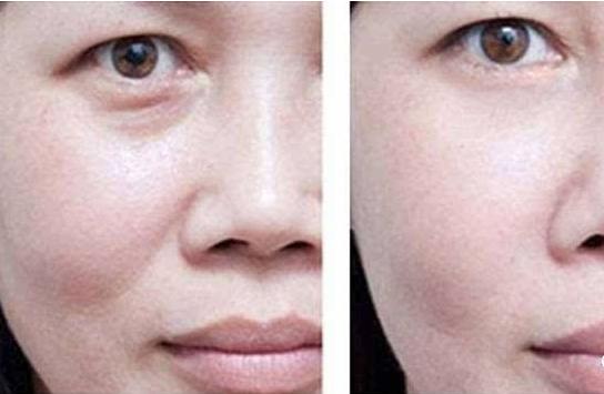 年纪轻轻就有了法令纹怎么改善,十几岁有法令纹了怎么改善