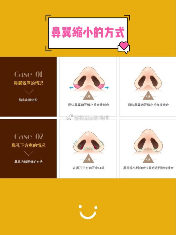 鼻翼肥大适合打鼻翼钉吗,鼻翼大怎么缩小且不留痕迹