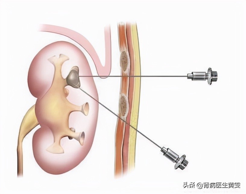 肾穿刺科普视频,关于肾部肿瘤穿刺活检