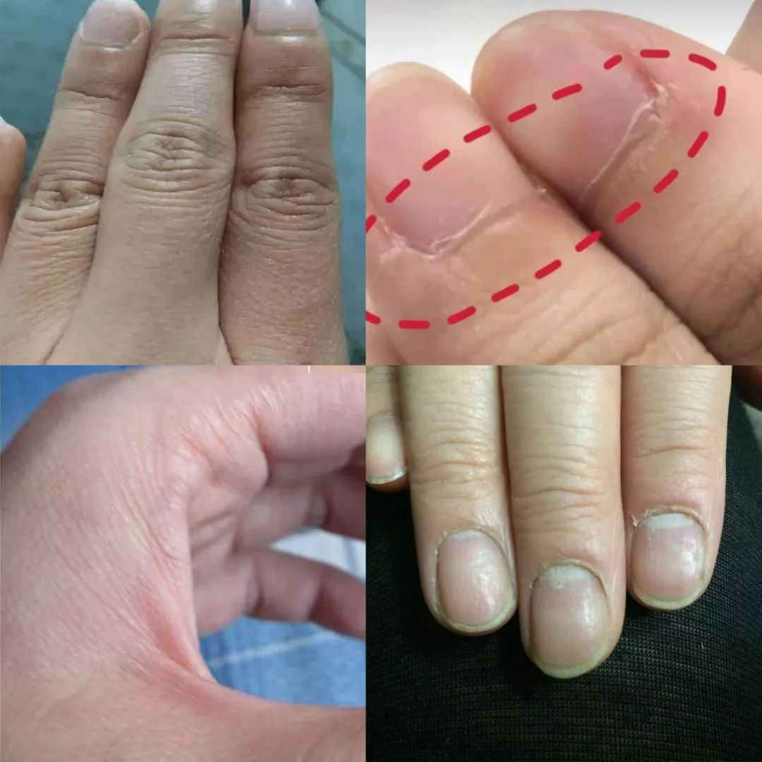 手纹深粗糙是不是比较好,手纹深粗糙干燥怎么办