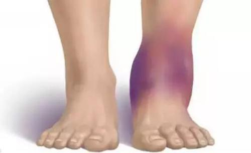 脚踝撕脱性骨折三个月一瘸一拐,脚踝撕脱性骨折骨头变大