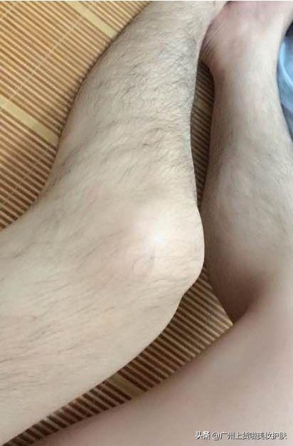 入夏前脱毛,脱毛必看小知识