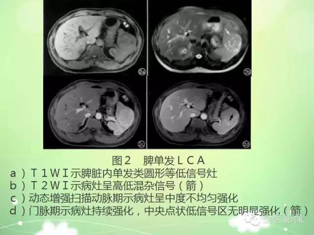 脾血管瘤中医辨证,脾血管瘤超声表现