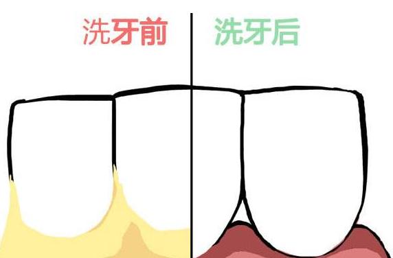 怎样才能够有效、健康的美白牙齿？做牙齿美白贵吗？