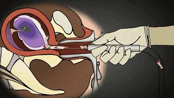 27岁未婚女孩6年做了17次人流：无痛人流，没你想得那么简单