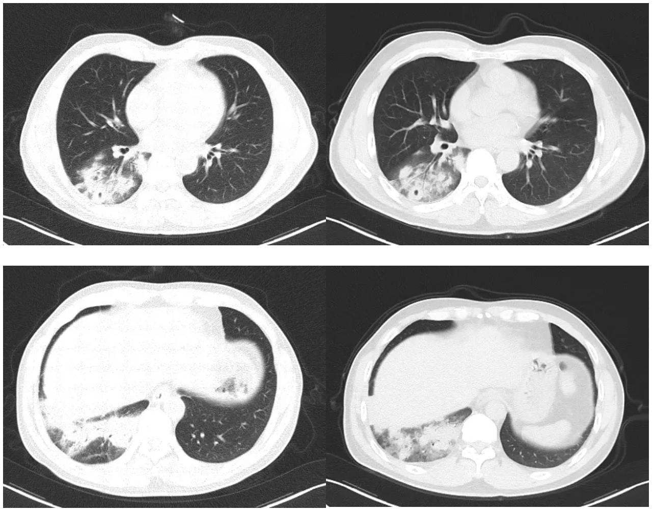 肺炎治疗7天症状好转ct无好转,肺炎治快二个月还没好