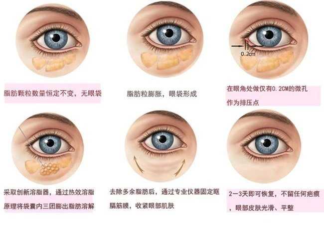 如何消除眼袋与黑眼圈,如何消除眼袋男生