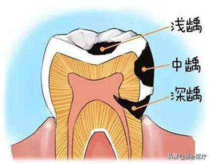 孕期牙疼最佳解决办法,孕期牙疼最好的缓解办法